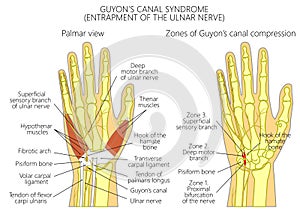 Entrapment of the ulnar nerve in the wrist in the GuyonÃ¢â¬â¢s canal 2